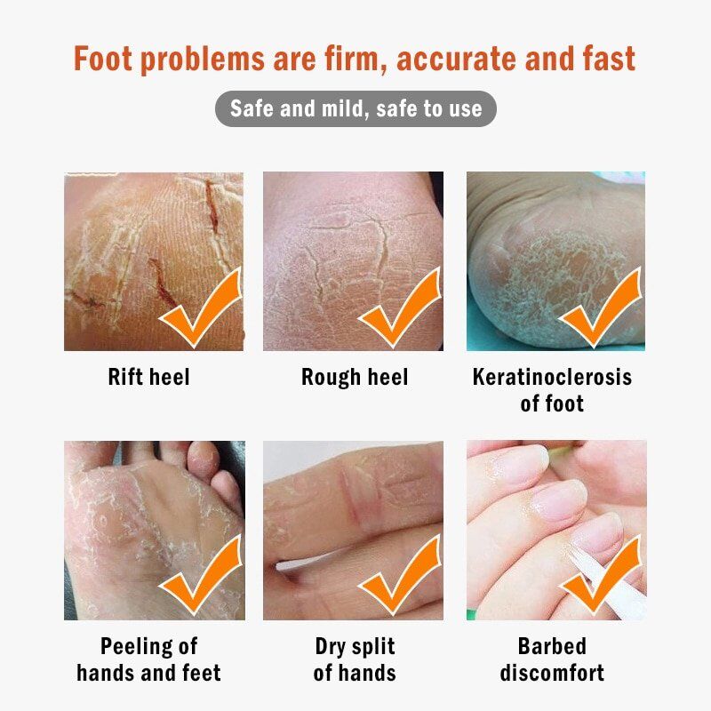 Banana Oil Foot , Crack Cream Heel, Chapped Peeling Foot , Repair Anti Dry Crack ,Remove Dead Skin , Soften Foot Care Cream. - Image 3