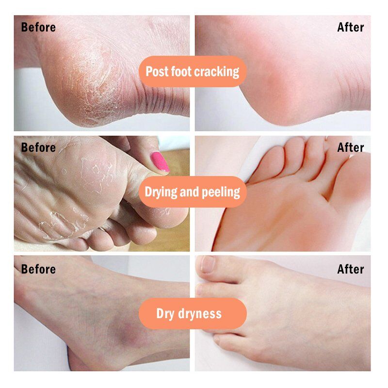 Banana Oil Foot , Crack Cream Heel, Chapped Peeling Foot , Repair Anti Dry Crack ,Remove Dead Skin , Soften Foot Care Cream. - Image 4