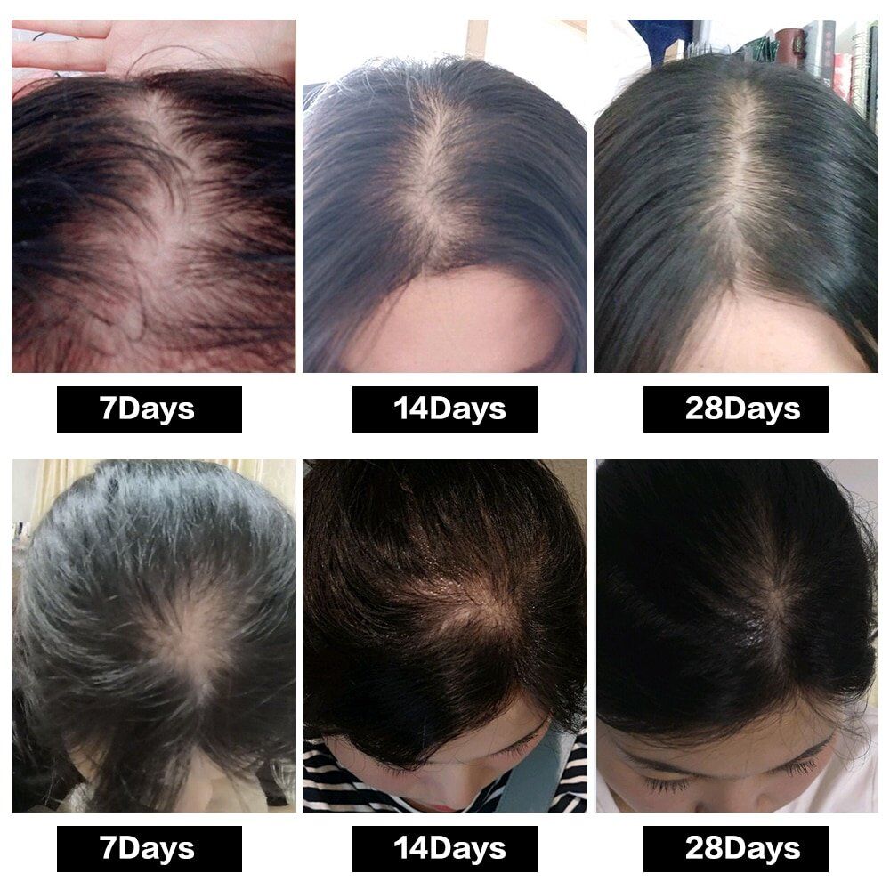Hair Growth Treatment, Oil for Anti Hair Loss , Essence Fast Thick Hair , Eyebrows , Support Natural Healthy Hair , Treatment for Women. - Image 6