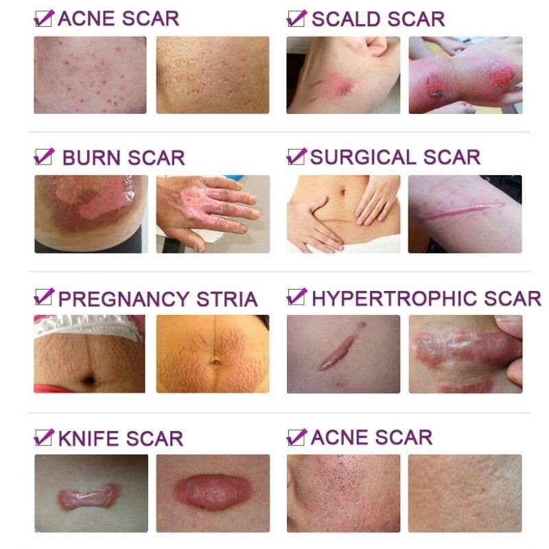 Lavender Scar Repair Cream , Moisturizing Lighten Pigment, Remove Scars ,Pimple Marks Acne, Spots, Treatment, Whitening Cream 30g. #NP - Image 4