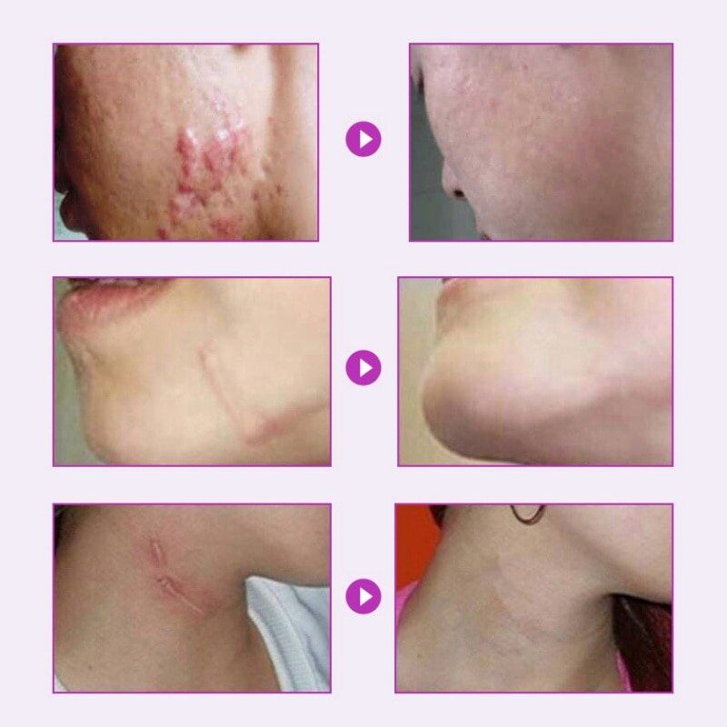 Lavender Scar Repair Cream , Moisturizing Lighten Pigment, Remove Scars ,Pimple Marks Acne, Spots, Treatment, Whitening Cream 30g. #NP - Image 5