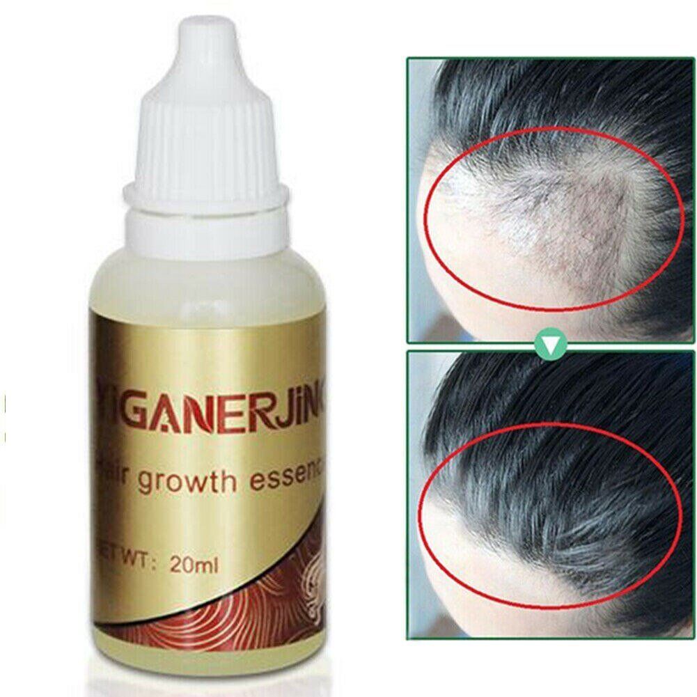 20ml 100% Natural Ginger Hair Growth Essential Oil.  Liquid Hair Loss . products leave-in Hair Scalp . Treatments for Hair Care .